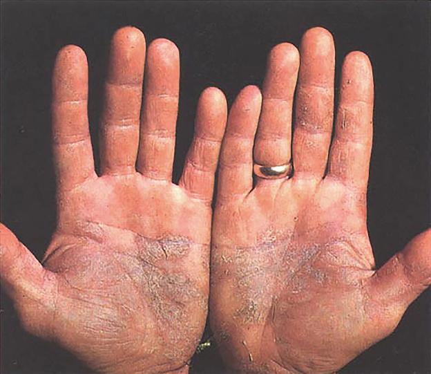 Remedios naturales para la psoriasis﻿