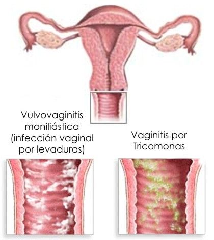 Síntomas de infección de levaduras 
