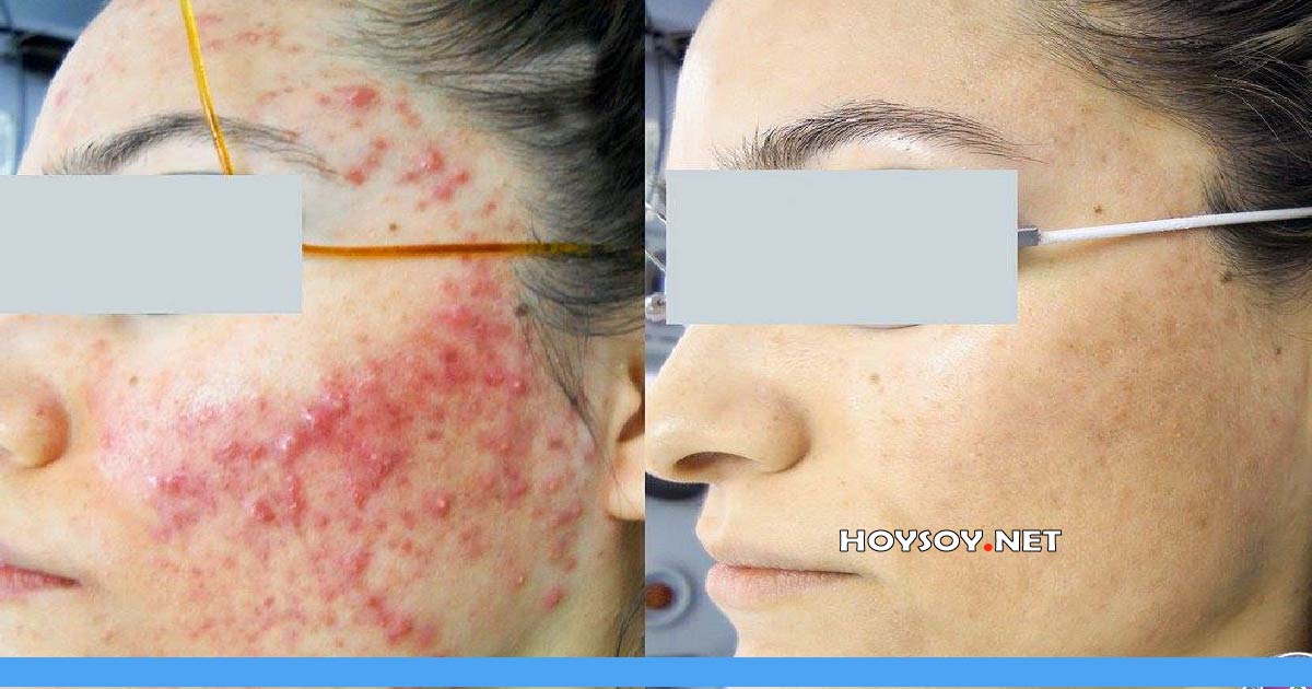 ANTIBIOTICOS PARA EL ACNE
