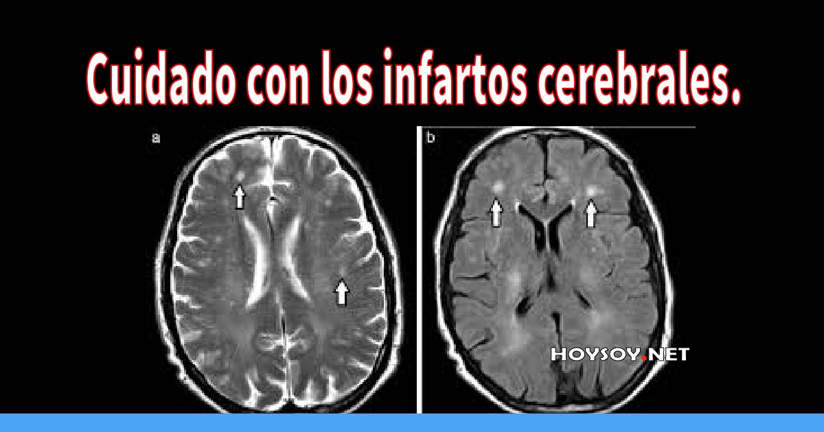 Cuidado con los infartos cerebrales.