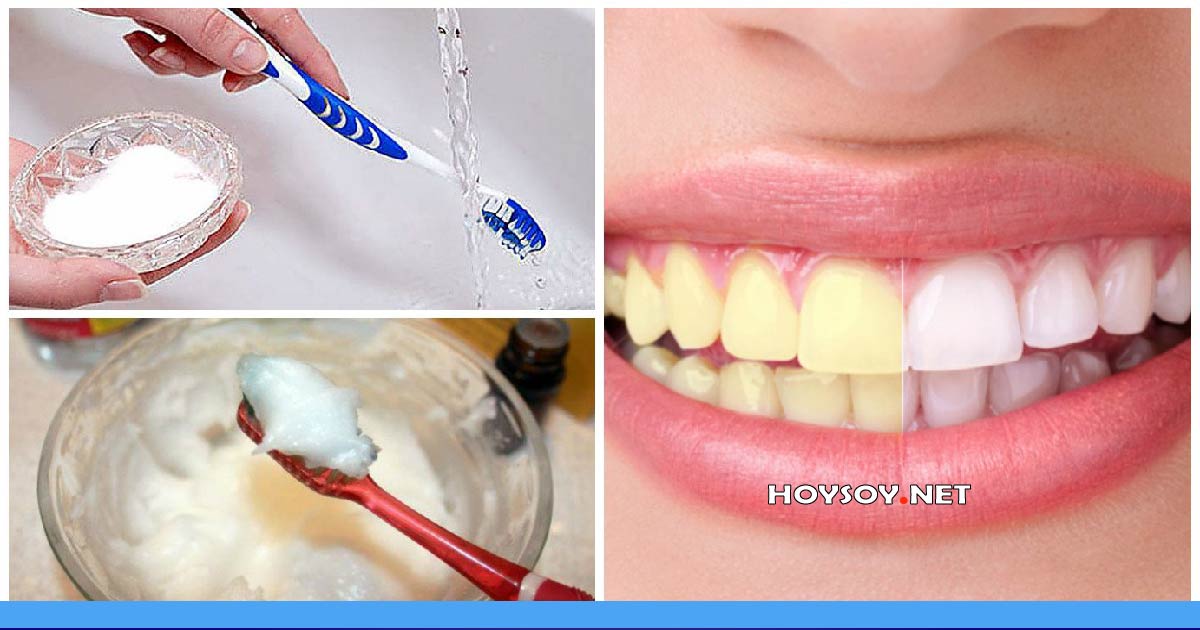 ¿Cómo blanquear los dientes?