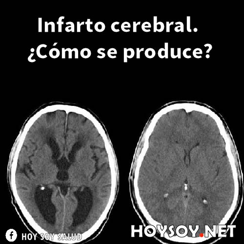 Infarto cerebral. ¿Cómo se produce?