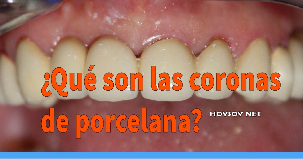 ¿Qué son las coronas de porcelana?