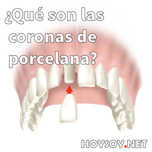 coronas de porcelana