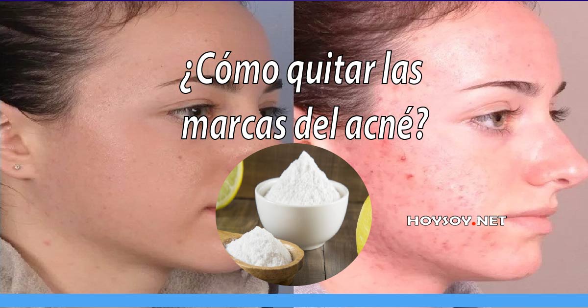Como quitar las marcas del acne