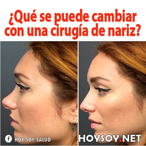 cirugía de nariz