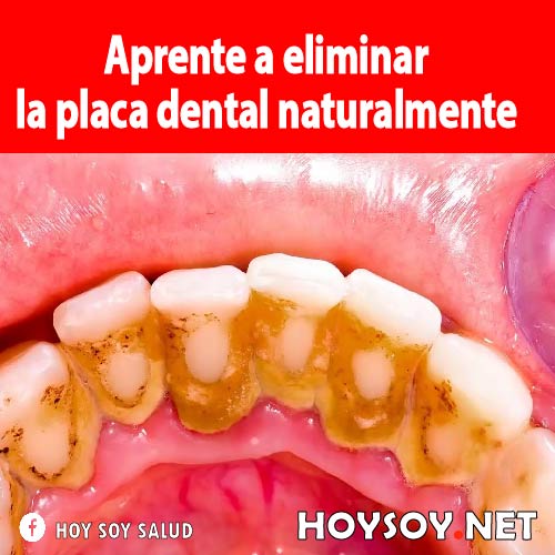 placa dental