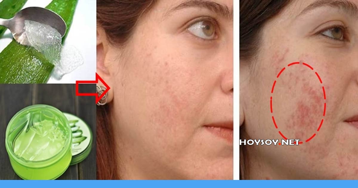 sábila para el acné