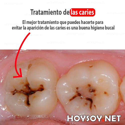 Tratamiento para las caries