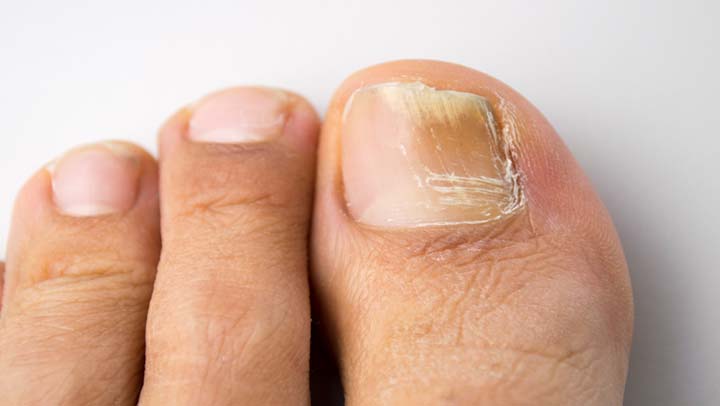 hongos en las uñas
