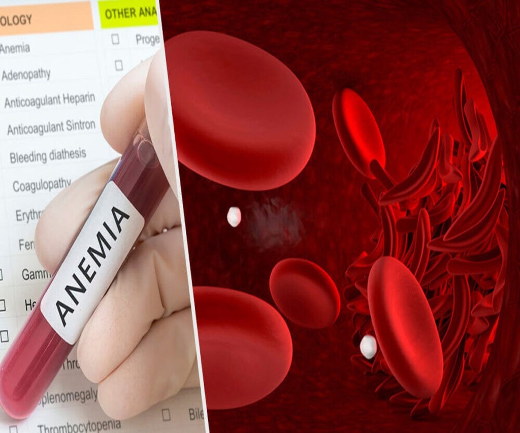 anemia