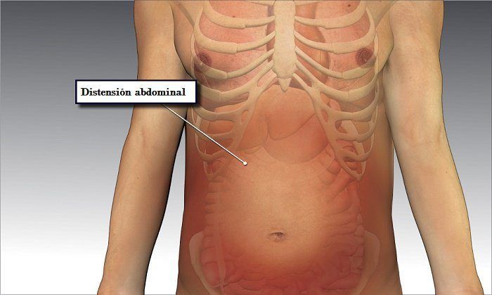 colitis