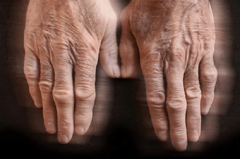 Parkinson