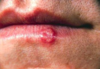 herpes labial