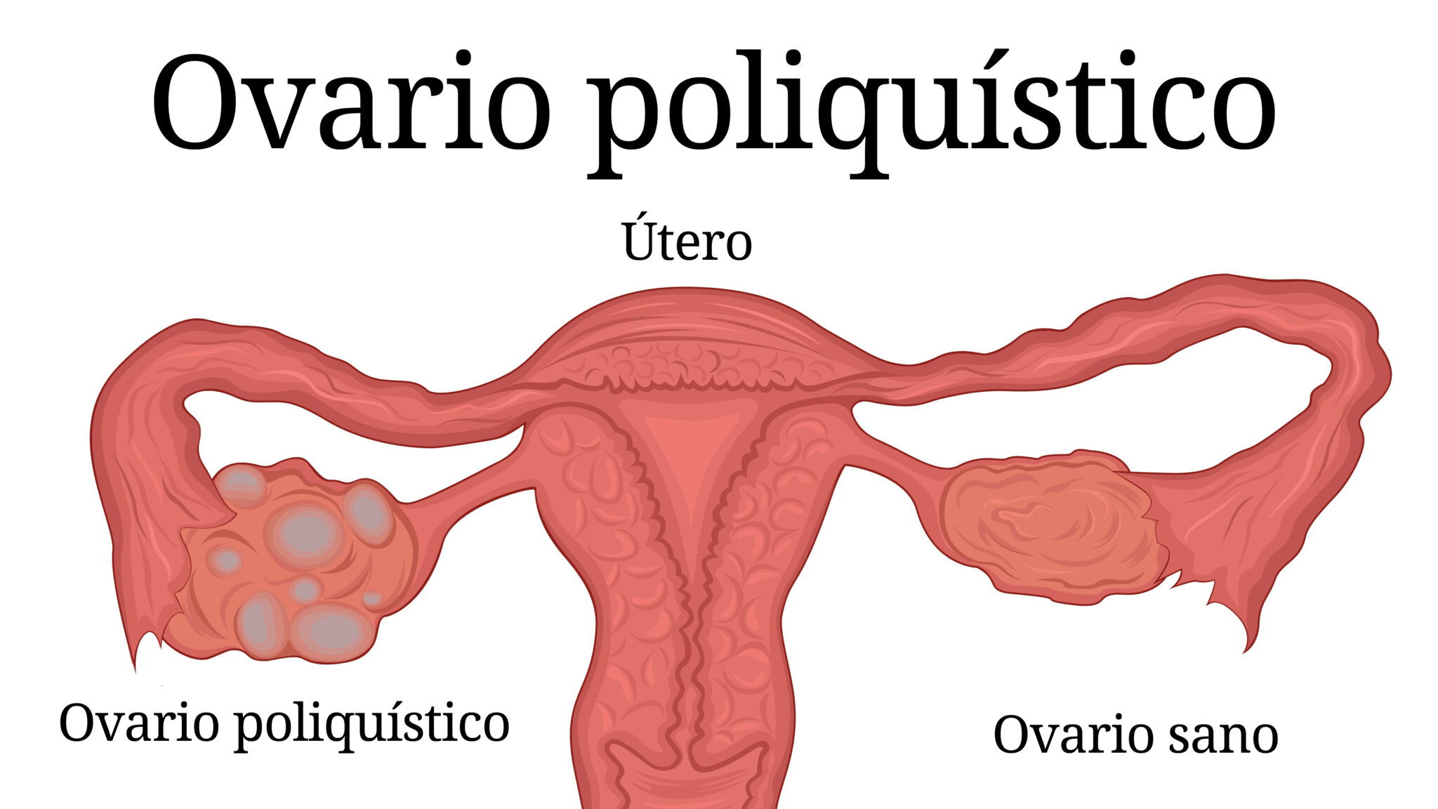 Dieta y Síndrome de Ovario Poliquístico SOP HOYSOY NET HOYSOY NET